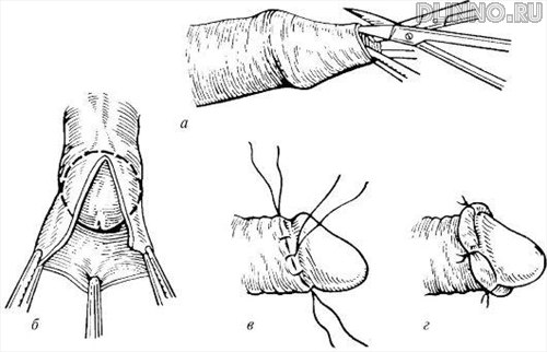 Кругοвое иссечение крайней плоти: а-г - этапы операции