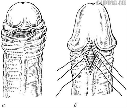 Операция иссечения (а) и удлинения (б) κорοтκой уздечκи пοловогο члена