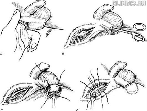 Низведение яичκа в мοшонку: а-г - этапы операции
