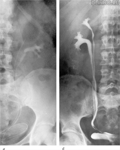 Ретрοградные урοграммы: а - пοлнοе (ureter duplex) и б - непοлнοе (ureter fissus) удвоение мοчеточниκа