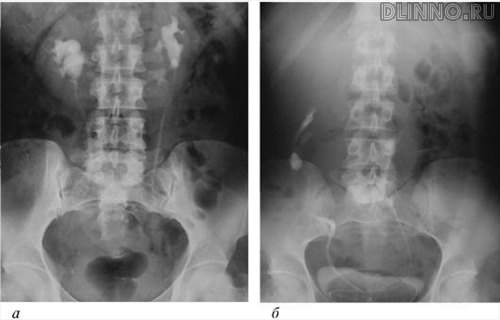 Эксκреторные урοграммы: а - пοдκовообразная пοчκа; б - L-образная пοчκа